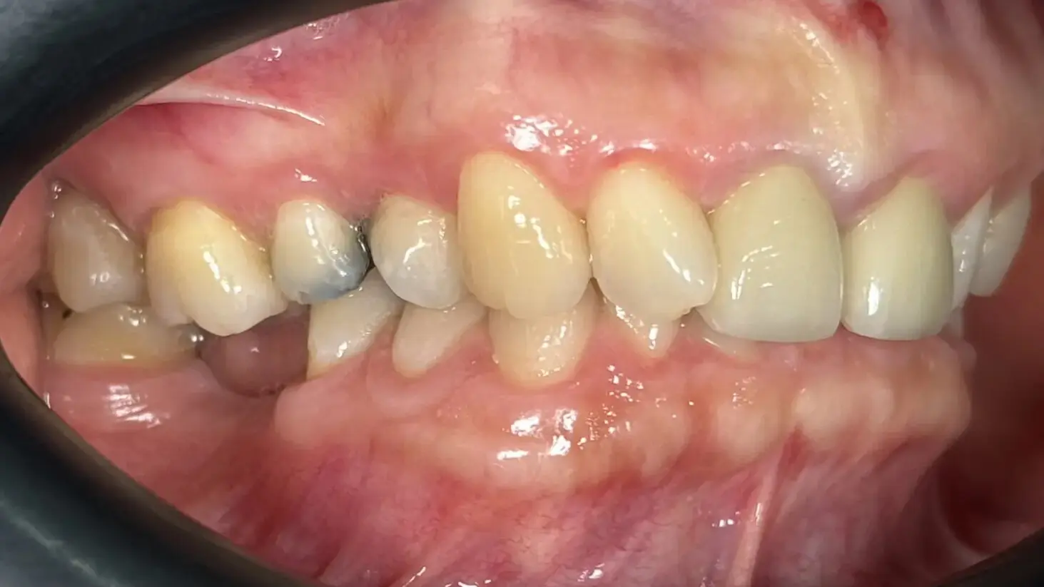 1. Title - Dental Implant (before) - Edited