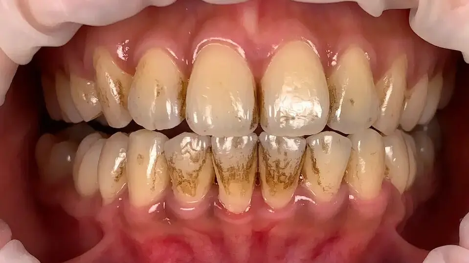 13. Title - Scaling & AirFlow Polishing (before) - Edited