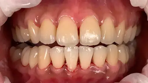 14. Title - Scaling & AirFlow Polishing (after) - Edited