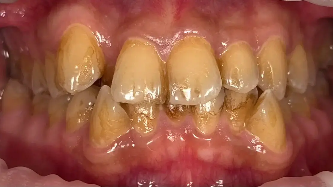 15. Title - Scaling & AirFlow Polishing (before) - Edited