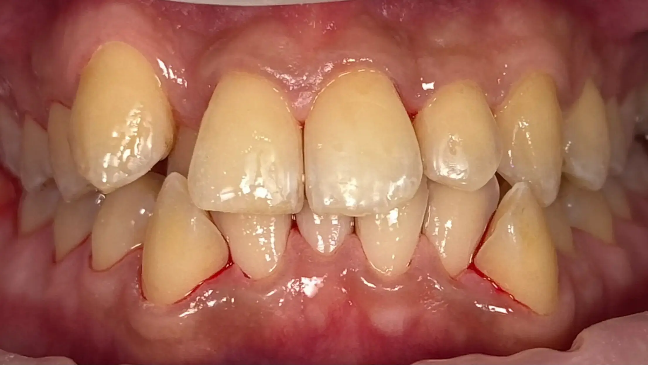 16. Title - Scaling & AirFlow Polishing (after) - Edited