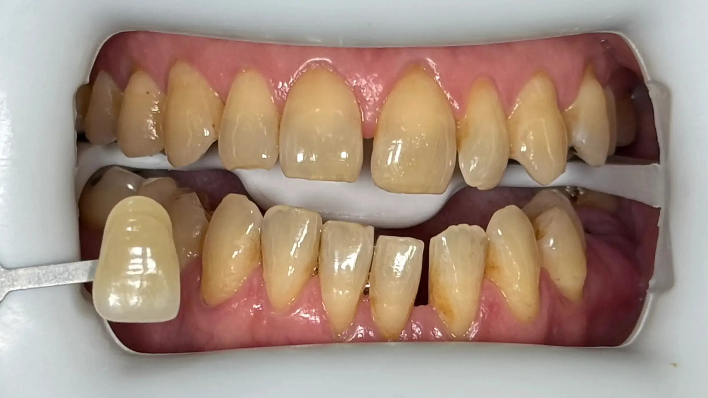 17. Title - Teeth Whitening (before) - Edited