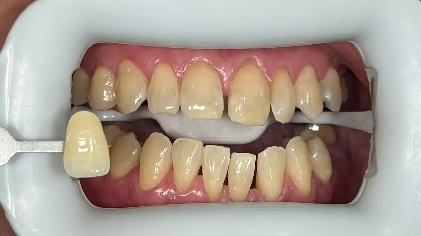 18. Title - Teeth Whitening (after) - Edited