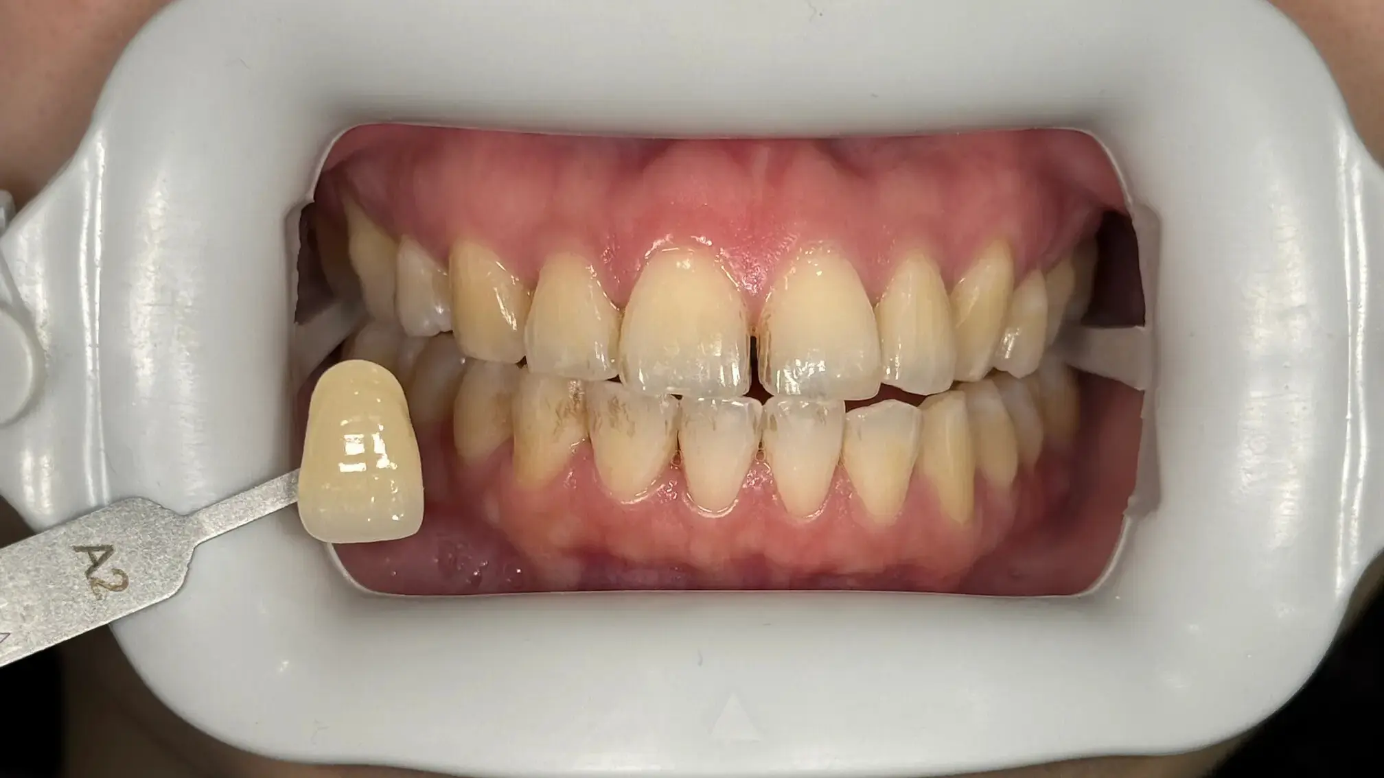 19. Title - Teeth Whitening (before) - Edited