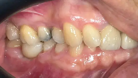 2. Title - Dental Implant (after) - Edited