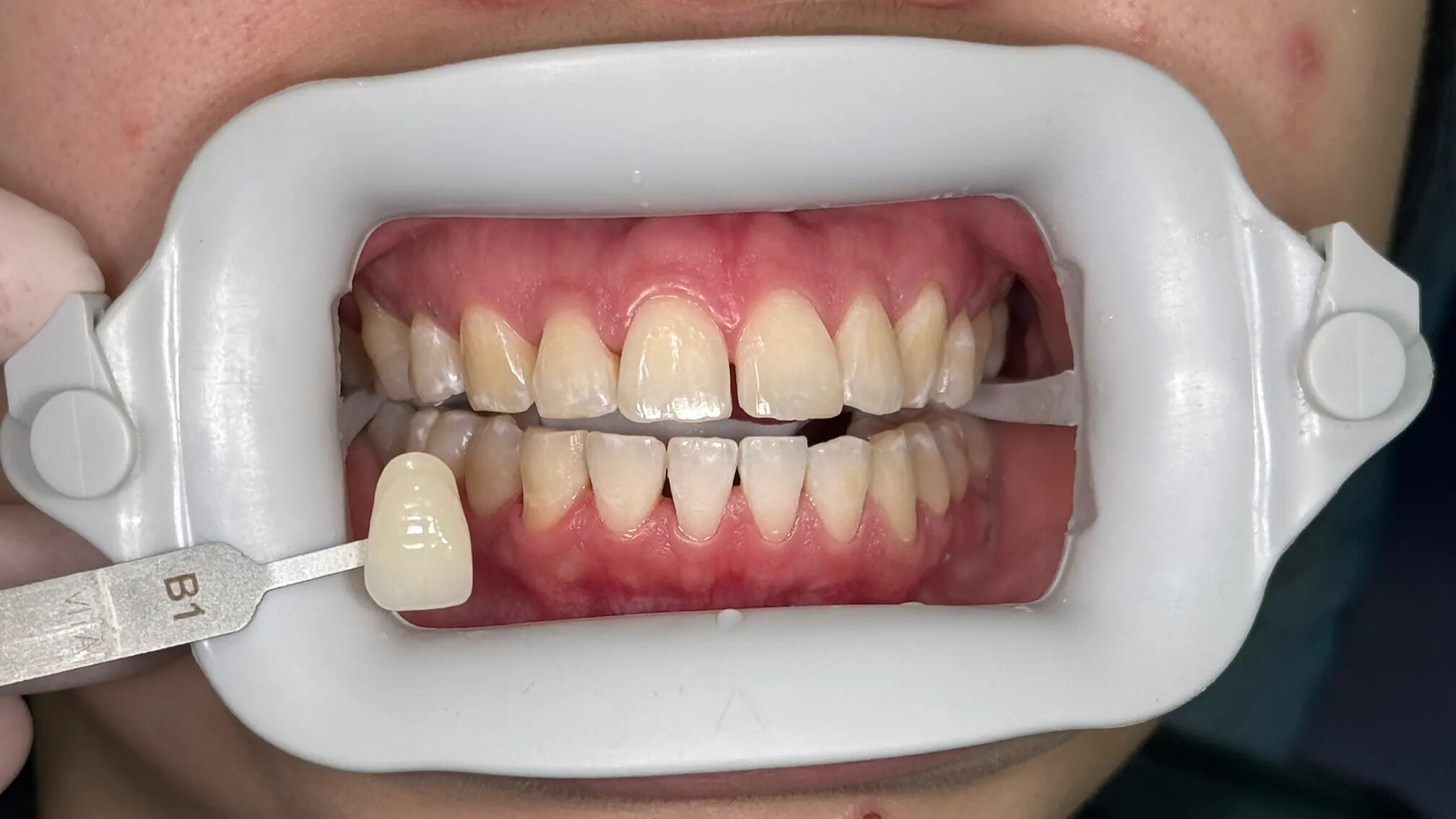 20. Title - Teeth Whitening (after) - Edited