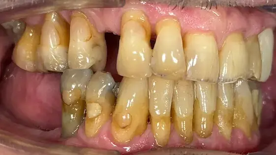 3. Title - Dental Implant (before) - Edited