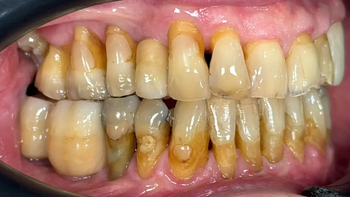 4. Title - Dental Implant (after) - Edited