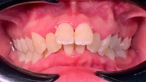5. Title - Damon Braces (before) - Edited