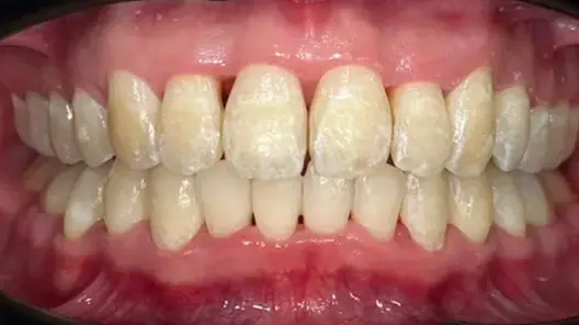 6. Title - Damon Braces (after) - Edited