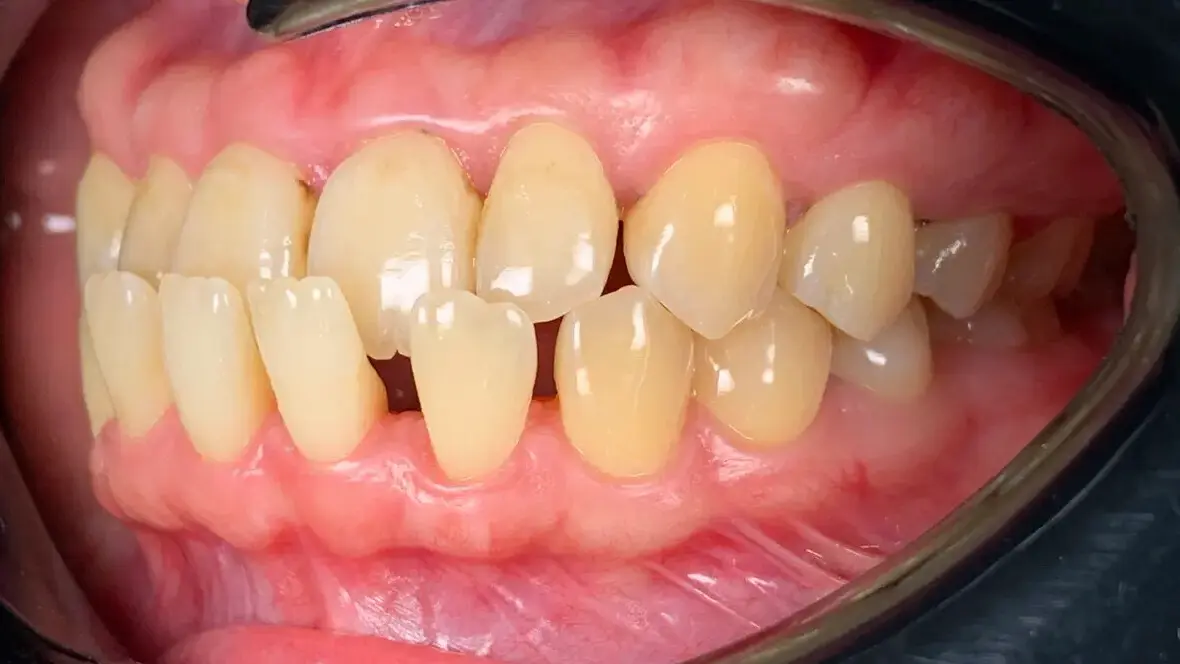 7. Title - Damon Braces (before) - Edited