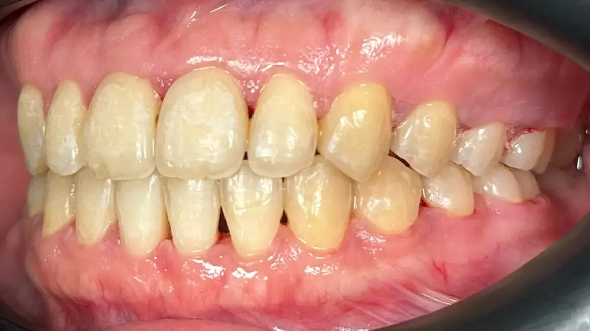 8. Title - Damon Braces (after) - Edited