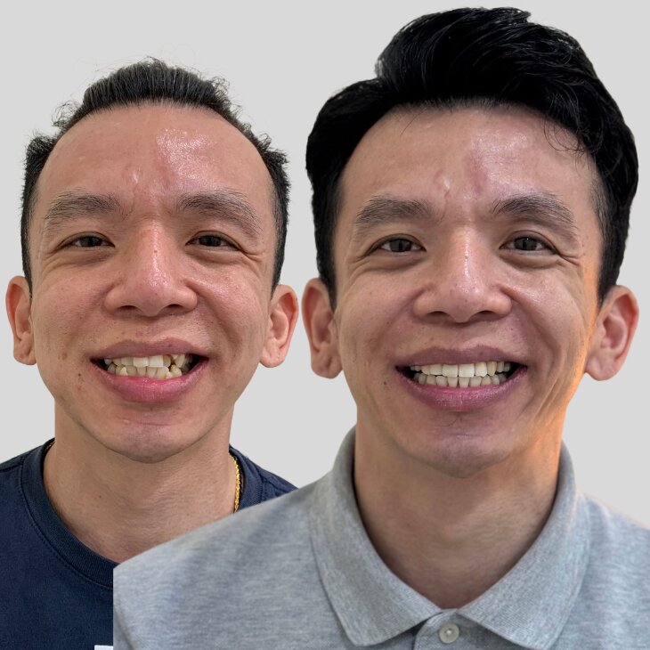 bro1